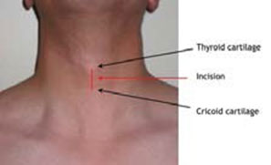 Diagram of where an incision should go between thyroid and cricoid cartilages