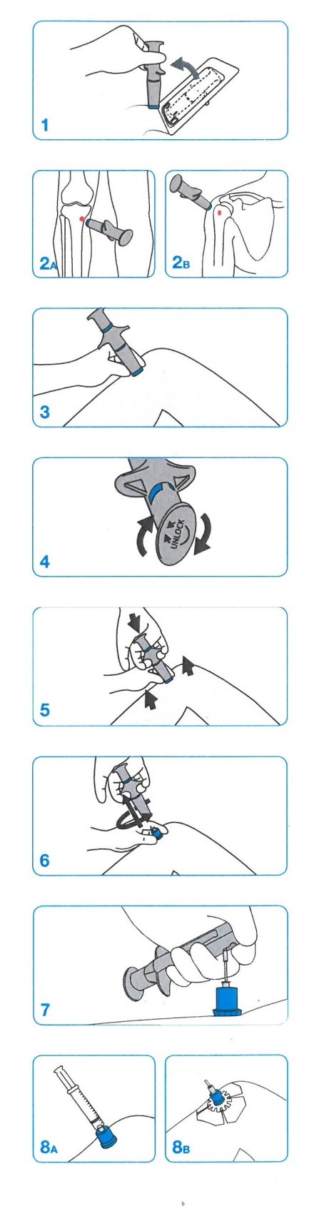 Diagram of the steps to Intraosseous Access using the NIO