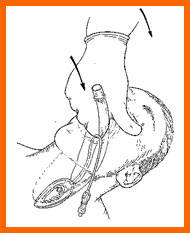 Laryngeal Mask Airway diagram