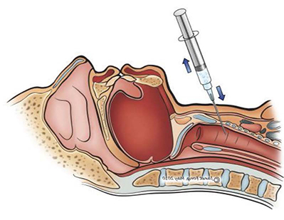 Needle cricothyrotomy diagram