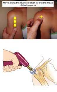 Diagram showing how to locate the point for Humeral Head Insertion