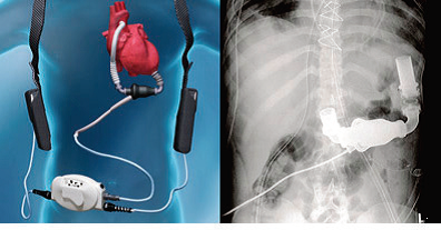 Ventricular Assist Device