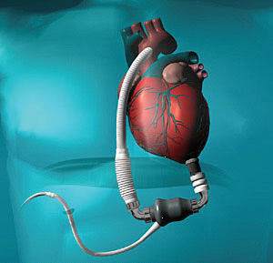 Ventricular Assist Device